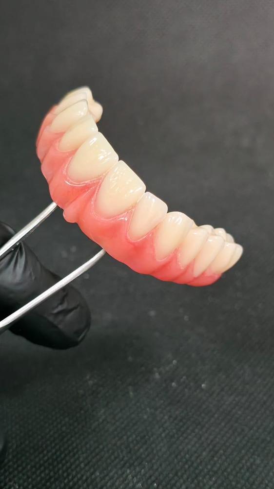 Prótese protocolo em acrílico, segurada por pinça